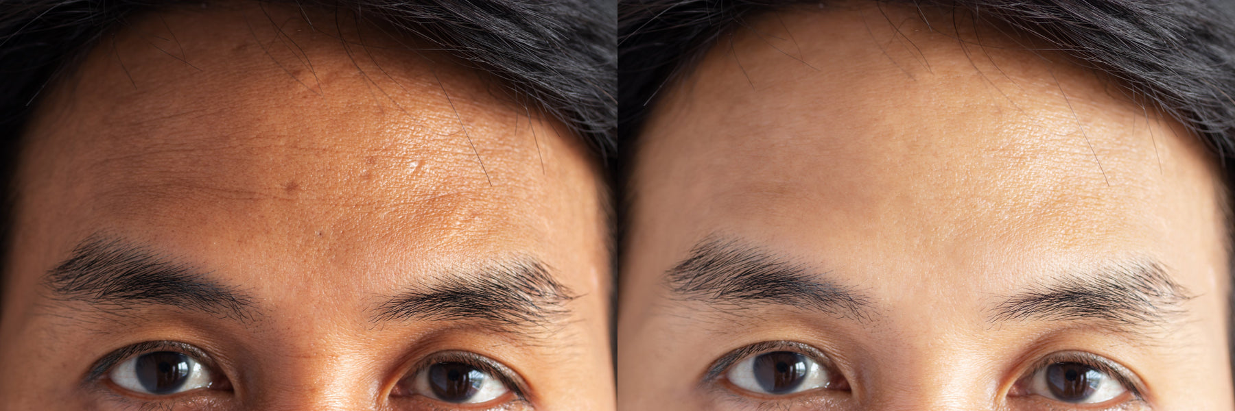 Facts About Skin Lighteners and Brighteners